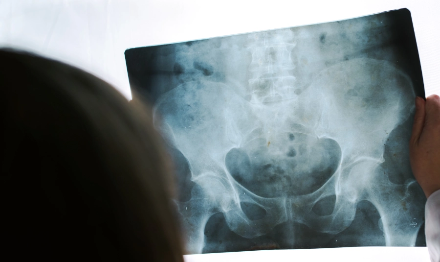 A doctor reviews a hip x-ray.