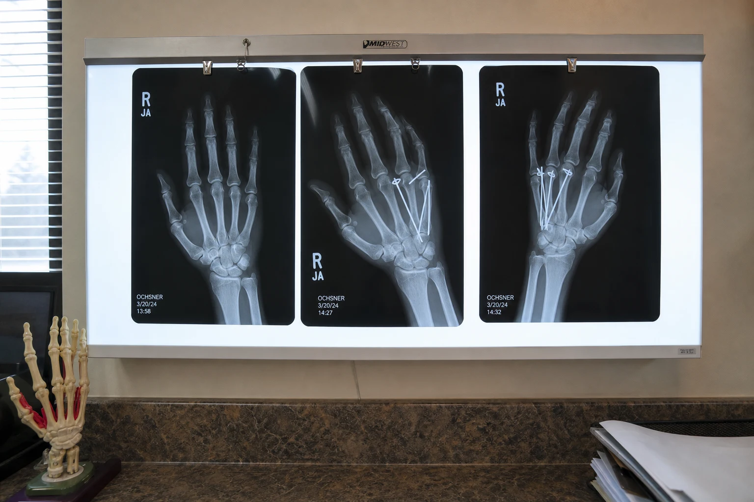 Fort Wayne hand injury scene — hand xray series